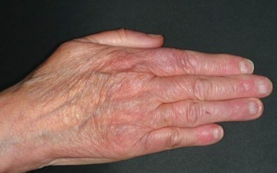 Acrodermatitis Chronica Atrophicans: Symptome & Therapie