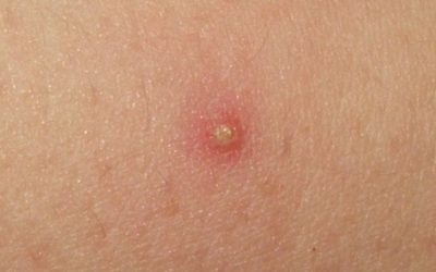 Follikulitis: Symptome & Therapie