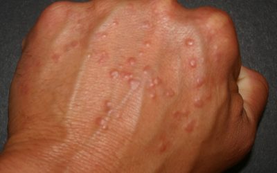 Granuloma anulare – Ursachen, Online-Diagnose & Behandlung