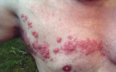 Gürtelrose: Ursachen, Online-Diagnose & Therapie durch Hautärzte