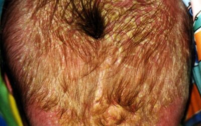 Infantile seborrhoische Dermatitis: Symptome und Therapie