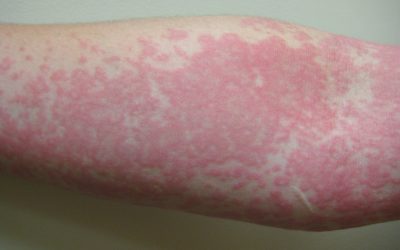 Hautausschlag – Online-Diagnose & Behandlung
