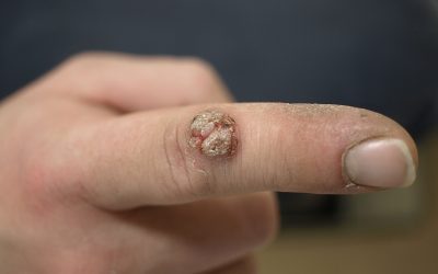 Warzen (HPV-Infektion): Symptome & Therapie