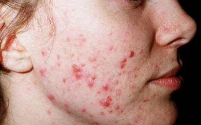 Komedone-Acne (Acne Vulgaris): Was ist das? Was hilft?