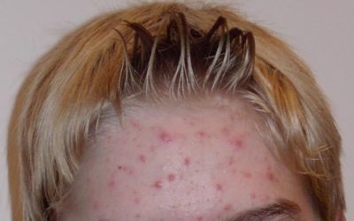 Akne – Ursachen, Online-Diagnose und Behandlung durch Hautärzte