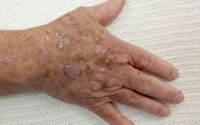 Aktinische Keratose – Aussehen, Online-Diagnose, Behandlung