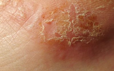 Allergisches Kontaktekzem: Ursachen, Symptome & Behandlung