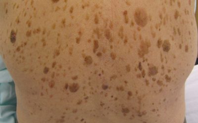 Alterswarzen (seborrhoische Keratose) – Online-Diagnose & Entfernung
