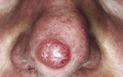 Basaliom (weißer Hautkrebs) – Online-Diagnose von Hautfachärzten