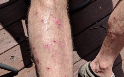 Bullöses Pemphigoid – Ursachen, Online-Diagnose, Verlauf und Therapie