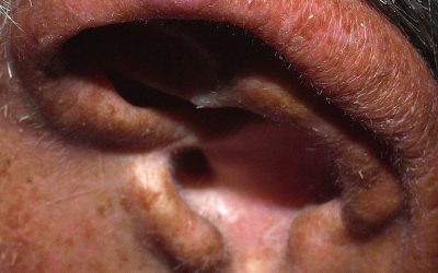Chondrodermatitis (Ohrknötchen) – Ursachen, Symptome und Behandlung