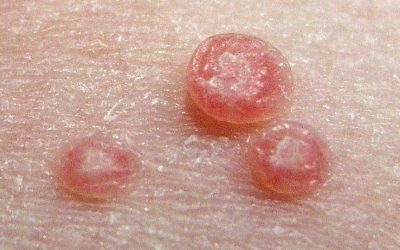 Dellwarzen (Mollusken) – Aussehen, Online-Diagnose & Therapie