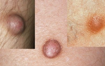 Dermatofibrom – was ist das?