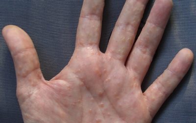 Dyshidrotisches Handekzem – Symptome und Behandlung