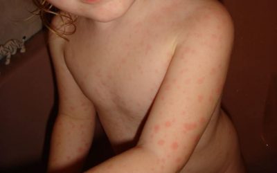Erythema multiforme – Symptome, Online-Diagnose und Therapie