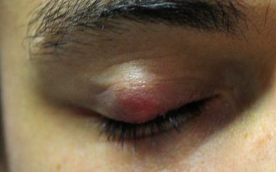Hagelkorn (Chalazion) – Online-Diagnose & Therapie durch Hautärzte
