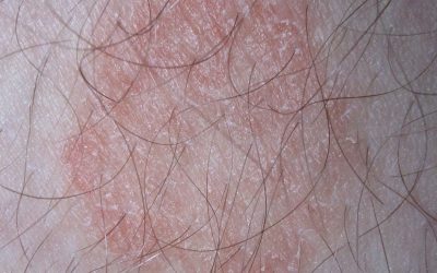 Hautpilz: Infektionswege, Online-Diagnose & Therapie durch Hautärzte