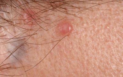 Hidradenom (Syringom): Aussehen, Online-Diagnose & Therapie