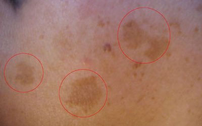Hyperpigmentierung: braune Hautverfärbungen