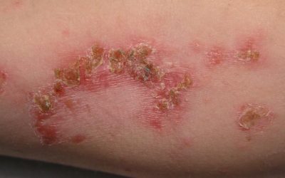 Impetigo Contagiosa (Grindflechte) – Symptome, Ursachen & Therapie