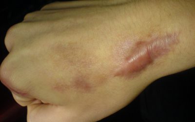 Hypertrophe Narben (Keloide) – Ursachen, Aussehen & Entfernung