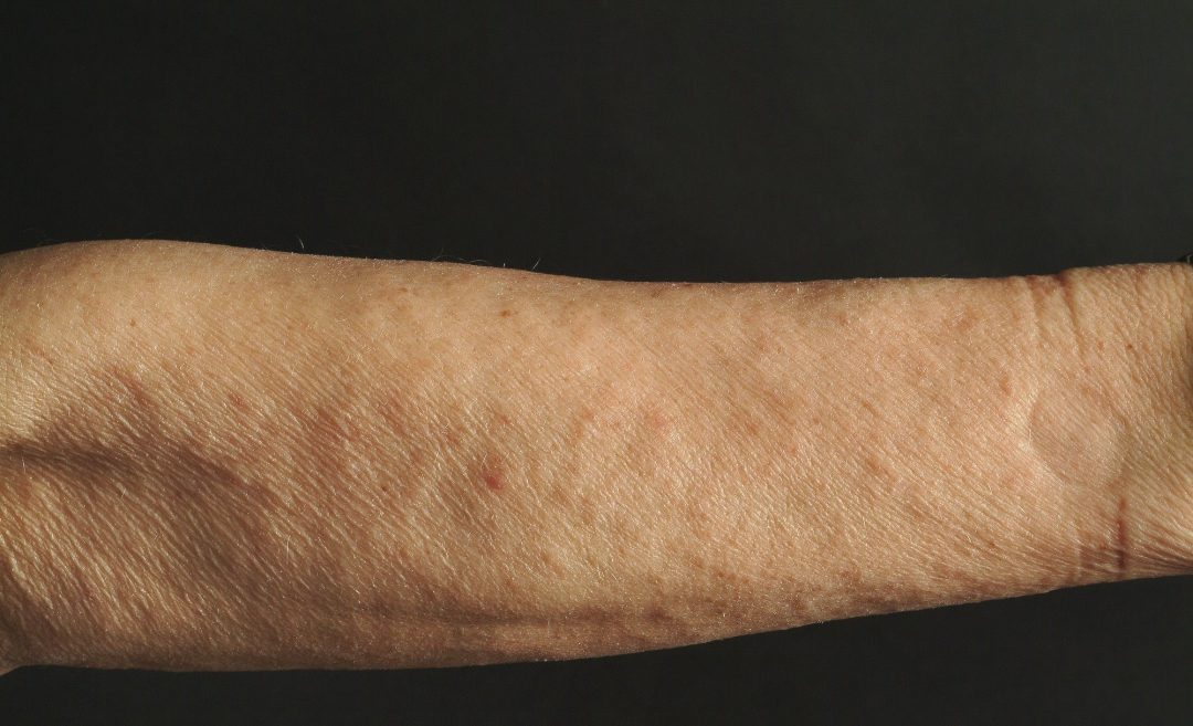 Reibeisenhaut (Keratosis Pilaris) - Gänsehaut als Dauerzustand