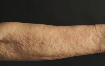 Keratosis Pilaris (Reibeisenhaut): Online-Diagnose & Hilfe von Hautärzten