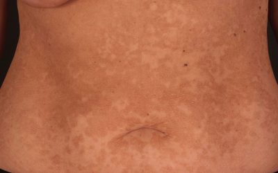 Kleieflechte (Pityriasis versicolor) – Ursachen, Symptome & Therapie