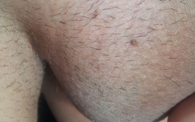 Feigwarzen: Ansteckung, Online-Diagnose & Behandlung durch Hautärzte