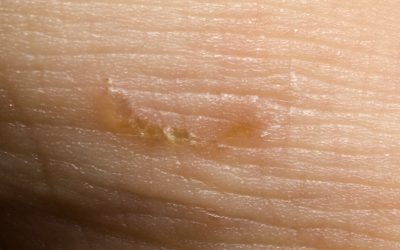 Krätze (Skabies) – Ursachen, Online-Diagnose & Therapie durch Hautärzte