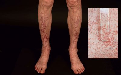 Leukozytoklastische Vaskulitis – Symptome und Therapie