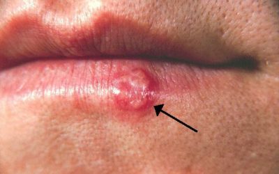 Lippenherpes (Herpes labialis): Ursachen, Symptome & Therapie