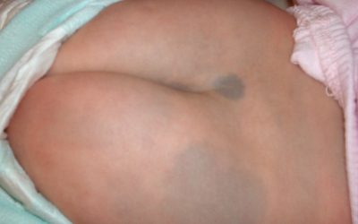 Der Mongolenfleck – besonderes Mal mit besonderem Namen