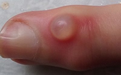 Die Mukoidzyste – Erscheinungsformen, Online-Diagnose und Therapie