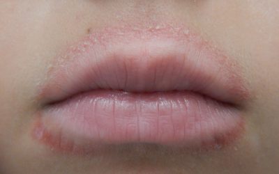 Die Mundrose (periorale Dermatitis) – Symptome, Diagnose und Therapie
