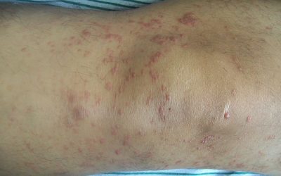 Mycosis fungoides – Ursachen, Symptome und Therapie