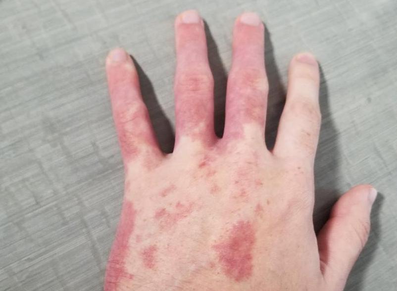 Naevus Flammeus Feuermal Ursachen Begleiterkrankungen Therapie