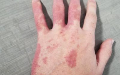 Naevus flammeus (Feuermal): Ursachen, Begleiterkrankungen & Therapie