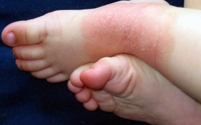 Neurodermitis – Ursachen, Symptome, Verlauf und Behandlung