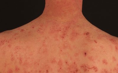 Nummuläre Dermatitis – Ursachen, Symptome und Therapie