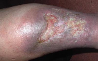 Ulcus cruris (offenes Bein): Ursachen, Diagnose, Therapie & Prognose