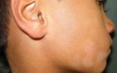 Pityriasis alba – Symptome & Therapie
