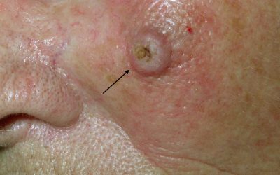 Plattenepithelkarzinom (Spinaliom, weißer Hautkrebs): Online-Diagnose