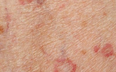 Porokeratose (Porokeratosis) – Symptome, Ursachen und Behandlung
