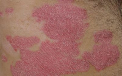 Schuppenflechte (Psoriasis) – Ursachen, Symptome, Verlauf & Therapie