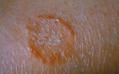 Ringelflechte (Tinea corporis) – Ursachen, Symptome & Therapie
