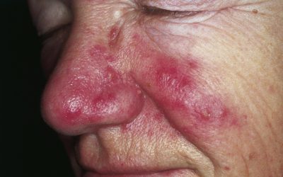 Rosazea – Ursachen, Online-Diagnose & Behandlung von Hautärzten