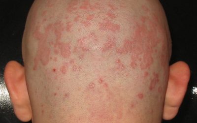 Seborrhoisches Ekzem – Ursachen, Online-Diagnose & Therapie