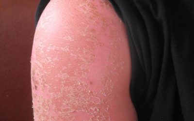 Erste Hilfe bei Sonnenbrand – Empfehlungen von Hautärzten