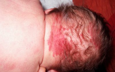 Storchenbiss (Nävus Unna) – Ursache, Entwicklung, Wortschöpfung